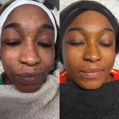 Hyperpigmentation Transformation Plan