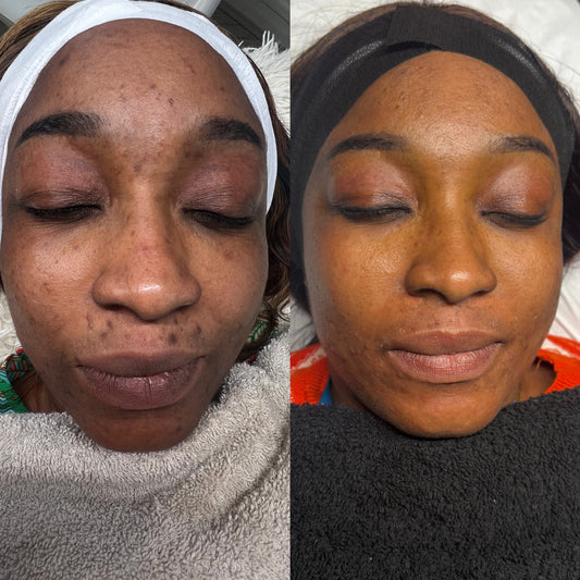 Hyperpigmentation Transformation Plan
